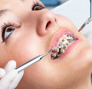 آیا برای ارتودنسی کشیدن دندان ضروری است؟