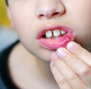 آفت دهان نشانۀ چیست؟