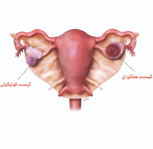 کیست فولیکولی تخمدان و علائم آن 