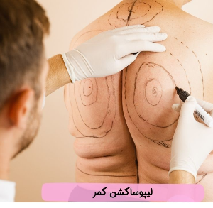 نکاتی درباره لیپوساکشن